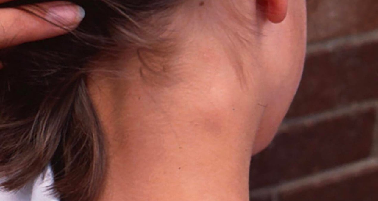 boyunda olusan sislikler ciddi hastalik belirtisi olabilir vKzzuTmK